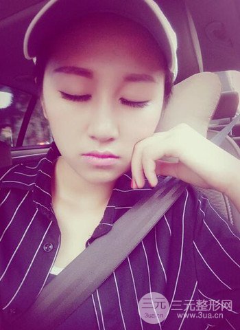 廣州隆鼻整形真實恢復期圖片，擁有精致美鼻不是夢