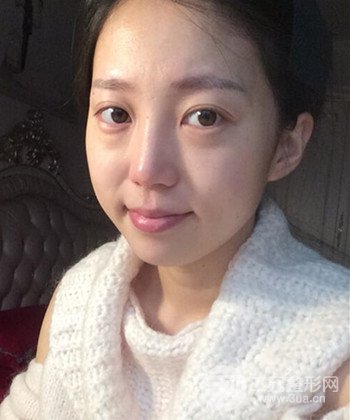 深圳內(nèi)切去眼袋+硅膠墊下巴真實(shí)案例恢復(fù)果圖