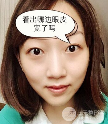 北京雙眼皮失敗修復(fù)手術(shù)日記分享，附上前后對(duì)比照片