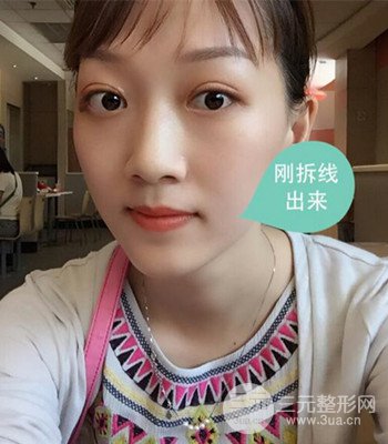 北京雙眼皮失敗修復(fù)手術(shù)日記分享，附上前后對(duì)比照片