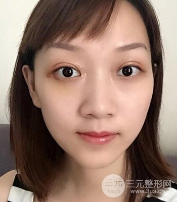 北京雙眼皮失敗修復(fù)手術(shù)日記分享，附上前后對(duì)比照片