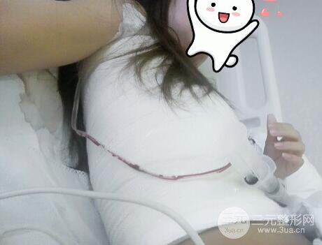 深圳假體隆胸讓平胸妹華麗變身，手術(shù)果分享