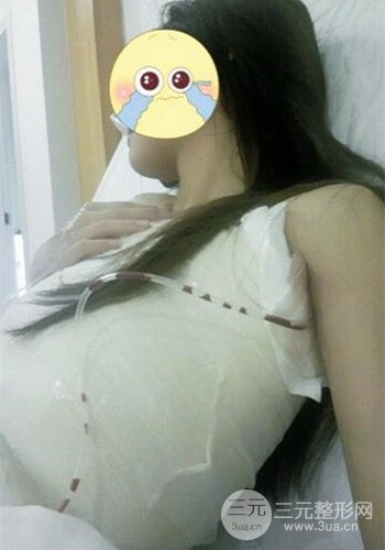 深圳假體隆胸讓平胸妹華麗變身，手術(shù)果分享