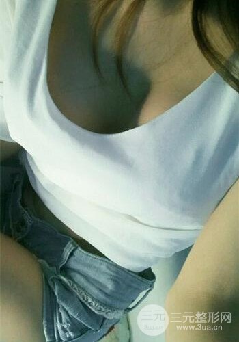 深圳假體隆胸讓平胸妹華麗變身，手術(shù)果分享