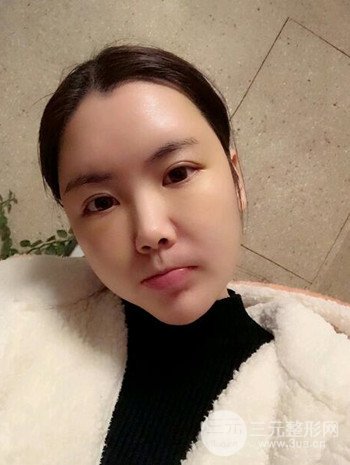 主播在深圳美臣做了自體脂肪全臉填充手術(shù)日記分享