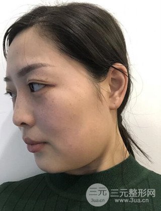 面部吸脂瘦臉手術(shù)日記分享,瘦臉果驚人