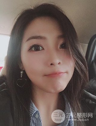 面部吸脂瘦臉手術(shù)日記分享,瘦臉果驚人