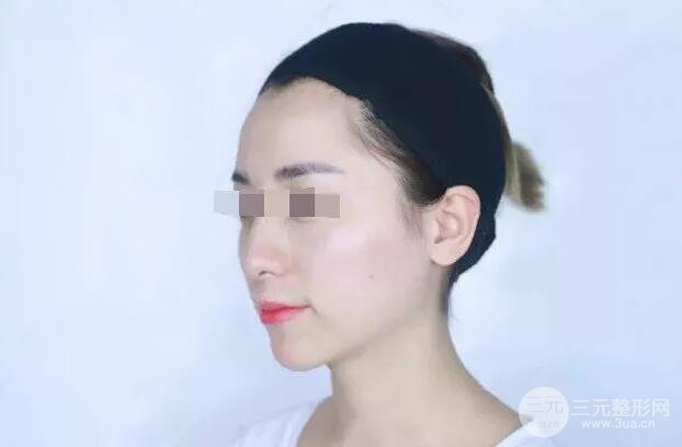 瑞蘭隆鼻多少錢 瑞蘭隆鼻真實一個月恢復前后對比圖案例