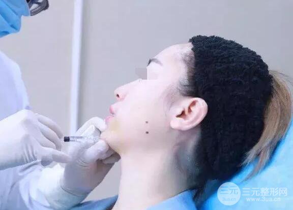 瑞蘭隆鼻多少錢 瑞蘭隆鼻真實一個月恢復前后對比圖案例