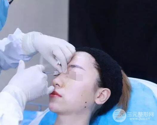 瑞蘭隆鼻多少錢 瑞蘭隆鼻真實一個月恢復前后對比圖案例