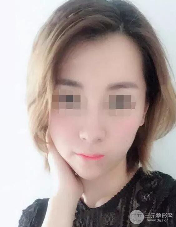 瑞蘭隆鼻多少錢 瑞蘭隆鼻真實一個月恢復前后對比圖案例