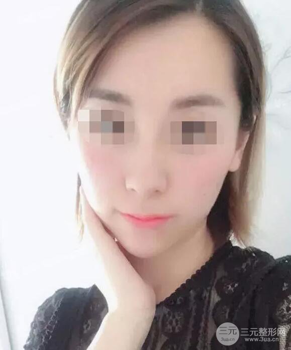 瑞蘭隆鼻多少錢 瑞蘭隆鼻真實一個月恢復前后對比圖案例