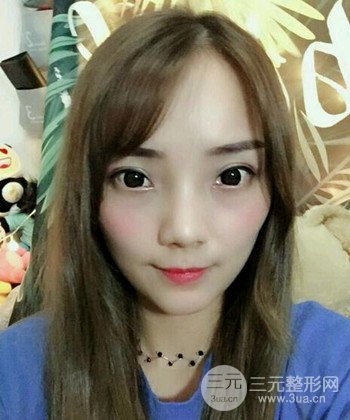 雙眼皮失敗修復(fù)手術(shù)日記分享，改變雙眼皮不對(duì)稱