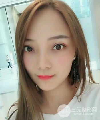 雙眼皮失敗修復(fù)手術(shù)日記分享，改變雙眼皮不對(duì)稱