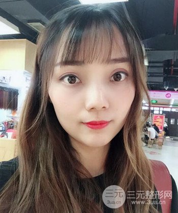 雙眼皮失敗修復(fù)手術(shù)日記分享，改變雙眼皮不對(duì)稱