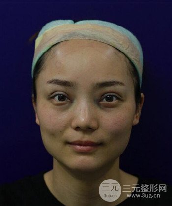 雙眼皮失敗修復(fù)手術(shù)日記分享，改變雙眼皮不對(duì)稱