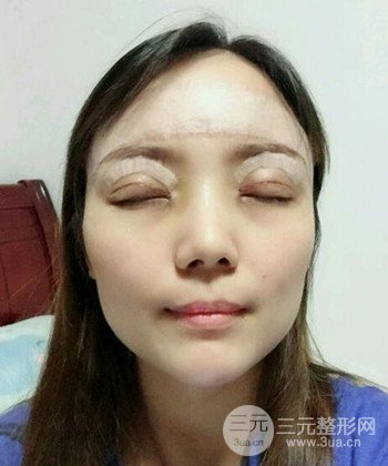雙眼皮失敗修復(fù)手術(shù)日記分享，改變雙眼皮不對(duì)稱
