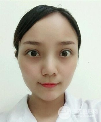 雙眼皮失敗修復(fù)手術(shù)日記分享，改變雙眼皮不對(duì)稱