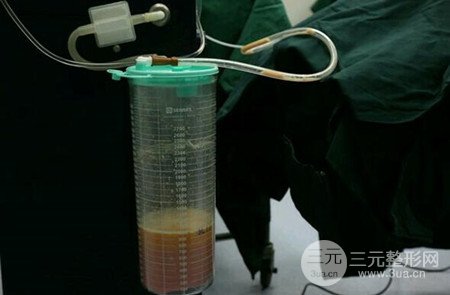 梨型身材做了大腿吸脂之后果超明X，吸脂恢復過程分享