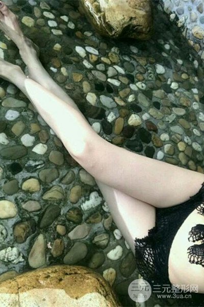 梨型身材做了大腿吸脂之后果超明X,吸脂恢復過程分享