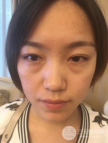 北京內(nèi)切祛眼袋真人案例果對比分享，年輕十歲不是夢