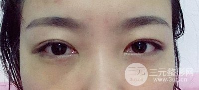 北京內(nèi)切祛眼袋真人案例果對比分享，年輕十歲不是夢