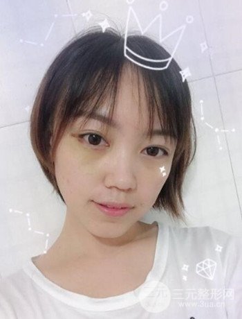 北京內(nèi)切祛眼袋真人案例果對比分享，年輕十歲不是夢