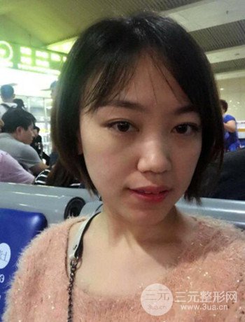 北京內(nèi)切祛眼袋真人案例果對比分享，年輕十歲不是夢