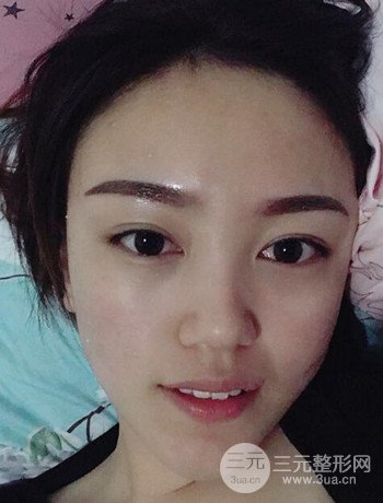 北京內(nèi)切祛眼袋真人案例果對比分享，年輕十歲不是夢