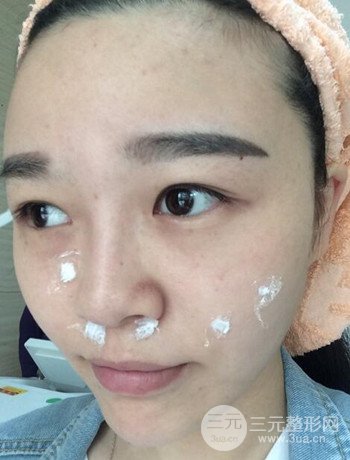 北京激光去雀斑真實案例分享，純素顏無濾鏡果圖