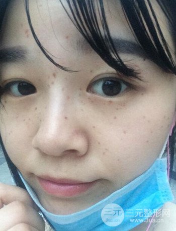 北京激光去雀斑真實案例分享，純素顏無濾鏡果圖