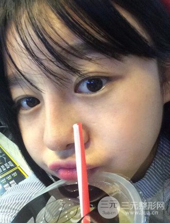 北京激光去雀斑真實案例分享，純素顏無濾鏡果圖