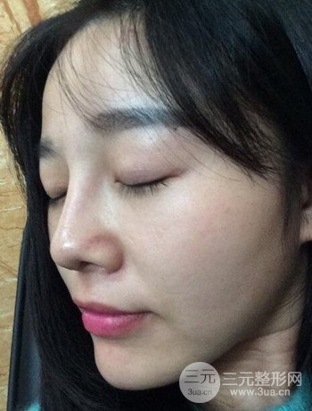 北京激光去雀斑真實案例分享，純素顏無濾鏡果圖