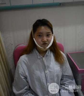 終于做了下頜角整形，分享術(shù)后恢復(fù)果