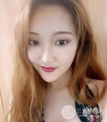 終于做了下頜角整形，分享術(shù)后恢復(fù)果