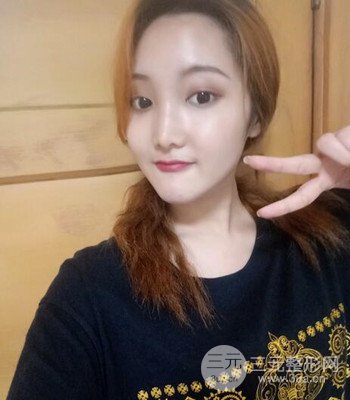 終于做了下頜角整形，分享術(shù)后恢復(fù)果