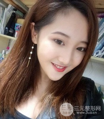 終于做了下頜角整形，分享術(shù)后恢復(fù)果