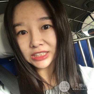 做了牙齒冷光美白果很棒,綻放美麗笑容