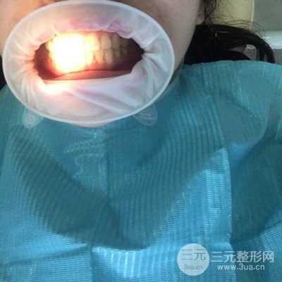 做了牙齒冷光美白果很棒,綻放美麗笑容