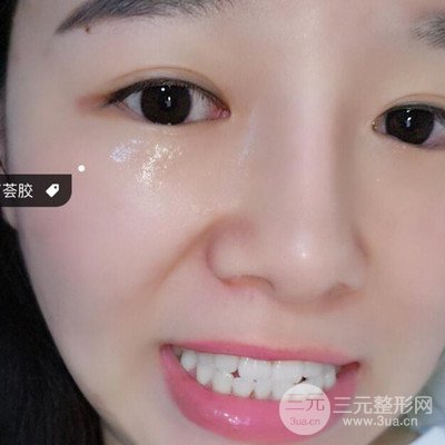 做了牙齒冷光美白果很棒,綻放美麗笑容