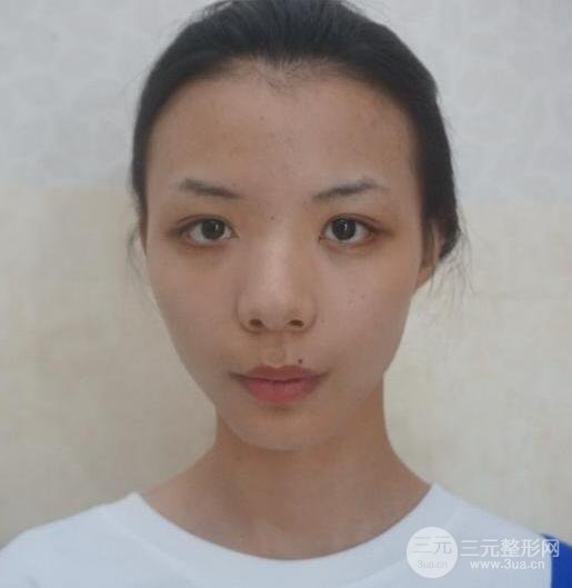 銀川崔大夫博士麗朱杰硅膠隆鼻恢復圖，輕松get精致臉