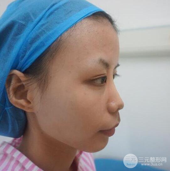 銀川崔大夫博士麗朱杰硅膠隆鼻恢復圖，輕松get精致臉