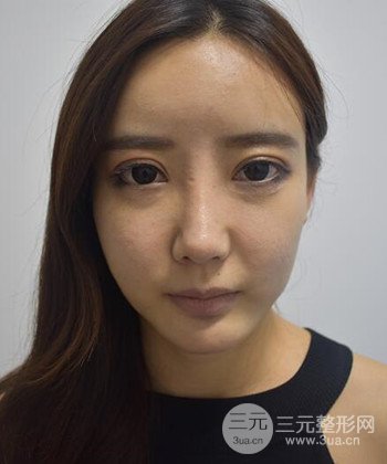 全臉自體脂肪填充手術(shù)日記分享，改良臉型年輕十歲