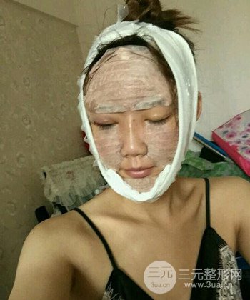 全臉自體脂肪填充手術(shù)日記分享，改良臉型年輕十歲