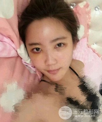 全臉自體脂肪填充手術(shù)日記分享，改良臉型年輕十歲