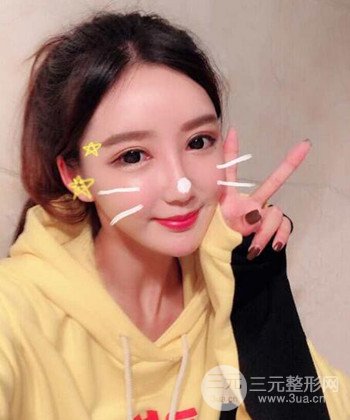 全臉自體脂肪填充手術(shù)日記分享，改良臉型年輕十歲