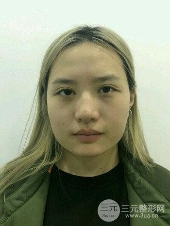 大圓臉做了面部吸脂瘦臉果很棒,立現(xiàn)漂亮鵝蛋臉