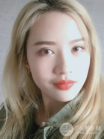 大圓臉做了面部吸脂瘦臉果很棒,立現(xiàn)漂亮鵝蛋臉