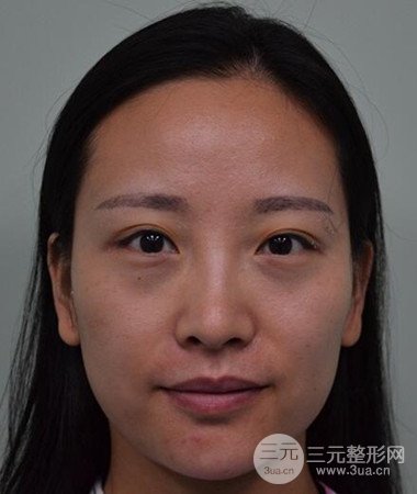 內(nèi)切微創(chuàng)去眼袋手術(shù)案例分享，附上手術(shù)恢復(fù)照片