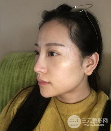 內(nèi)切微創(chuàng)去眼袋手術(shù)案例分享，附上手術(shù)恢復(fù)照片